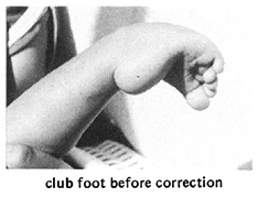 Club foot before correction.