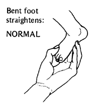 Bentfoot straightens: NORMAL