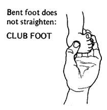 Bent foot does not straighten: CLUBFOOT
