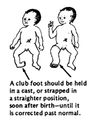A club foot should be held in a cast, or strapped in a straighter position, soon after birth-until it is corrected past normal.