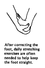 After correcting the foot, daily stretching exercises are often needed to help keep the foot straight. 