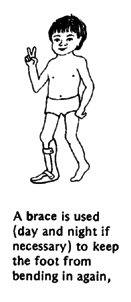 A brace is used (day and night if necessary) to keep the foot from bending in again,