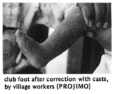 Club foot after correction with casts, by village workers (PROJIMO).