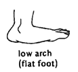 Low arch (flat foot)