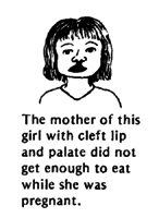 The mother of this girl with cleft lip and palate did not get enough to eat while she was pregnant.