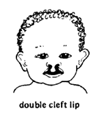 Double cleft lip.