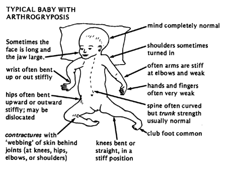 TYPICAL BABY WITH ARTHROGRYPOSIS