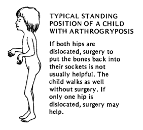 TYPICAL STANDIGN POSITION OF A CHILD WITH ARTHROGRYOSIS