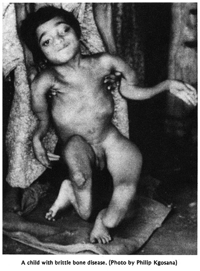 A child with brittle bone disease. (Photo by Philip Kgosana)