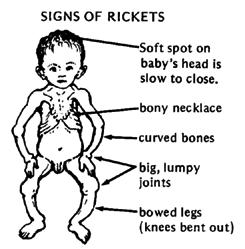 SIGNS OF RICKETS