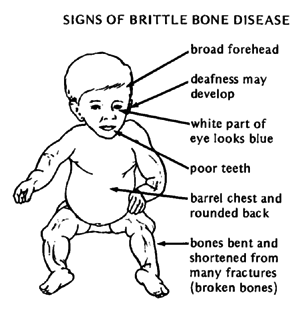 SIGNS OF BRITTLE BONE DISEASE