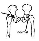 Cap of head of thigh bone.