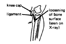 Be;ow-knee pain