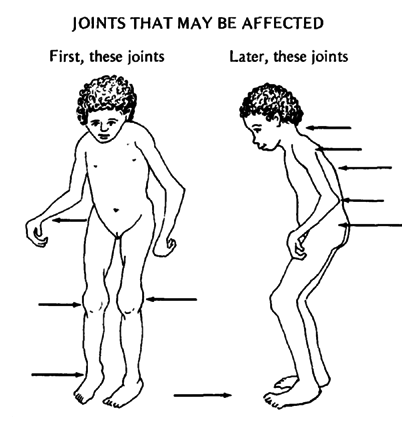 JOINTS THAT MAY BE AFFECTED