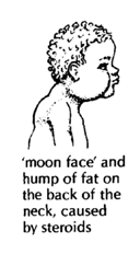 'Moon' face and hump of fat on the back of the neck, caused by steroids