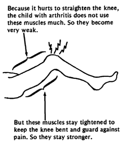 Because it hurts to straighten the knee, the child with arthritis does not use these muscles much. So they become very weak. But these muscles stay tightened to keep the knee bent and guard against pain. So they stay stronger.