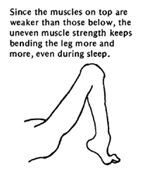 Since the muscles on top are weaker than those below, the uneven muscle strength keeps bending the leg more and more, even during sleep.