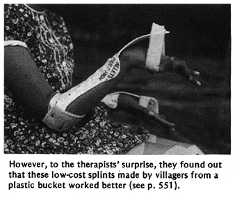 However, to the therapists' surprise, they found out that these low-cost splints made by villagers from a plastic bucket worked better