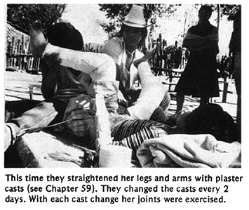 This time they straightened her legs and arms with plaster casts (see Chapter 59). They changed the casts every 2 days. With each cast change her joints were exercised.