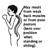 May result from weak back muscles or from poor posture (bent over position when standing or sitting).