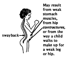 May result from weak stomach muscles, from hip contractures, or from the way a child walks to make up for a weak leg or hip.