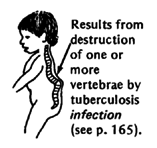  Results from destruction of one or more vertebrae by tuberculosis infection (see p. 165).