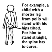 For example, a child with a shorter leg from polio will stand with his hips tilted. For him to stand straight, the spine has to curve.