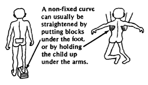 A non-fixed curve can usually be straightened by putting blocks under the foot, or by holding the child up under the arms.