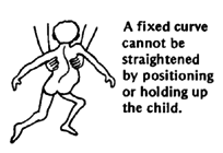 A fixed curve cannot be straightened by positioning or holding up the child.