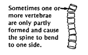 Sometimes one or more vertebrae are only partly formed and cause the spine to bend to one side.