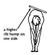 A higher rib hump on one side.