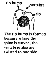 The rib hump is formed because where the spine is curved, the vertebrae also are twisted to one side.