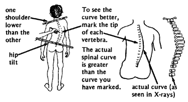 To see the curve better mark the tip of each vertebra. The actual spinal curve is greater than the curve you have marked.