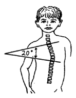 For each curve, pick the 2 vertebrae that tilt most in relation to each other.