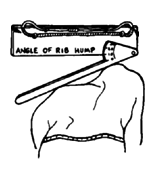 A homemade level for measuring rib hump angle