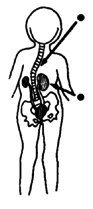 Curve of the spine, Urinary infections & kidney damage