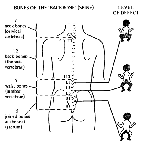 can babies born with spina bifida walk