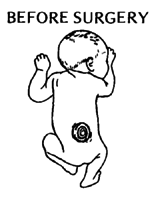 BEFORE SURGERY