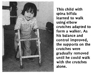 This child with spina bifida learned to walk using elbow crutches adapted to form a walker. As his balance and control improved, the supports on the crutches were gradually removed until he could walk with the crutches alone.