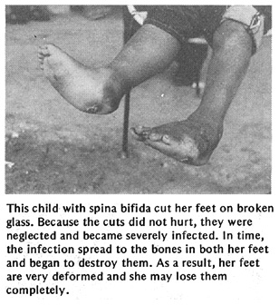  This child with spina bifida cut her feet on broken glass. Because the cuts did not hurt, they were neglected and became severely infected. In time, the infection spread to the bones in both her feet and began to destroy them. As a result, her feet are very deformed and she may lose them completely.