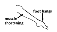 Paralyzed parts that tend to hang in one position.