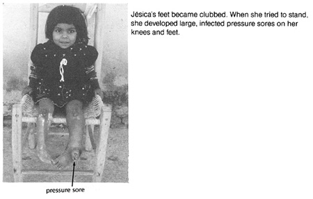 Jesica's feet became clubbed.
