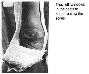 They left 'windows' in the casts to keep treating the sores.