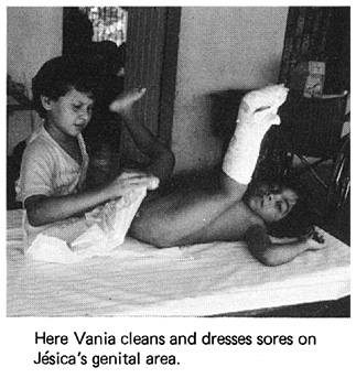 Here vania cleans and dresses sores on Jesica's gential area.