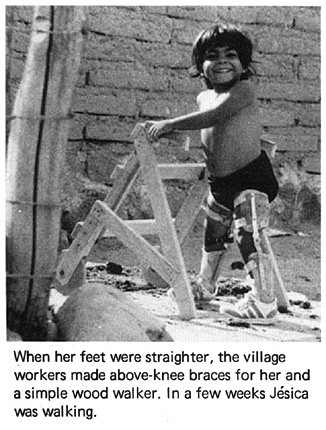 When her feet were straighter, the village workers made above-knee braces for her and a simple wood walker.