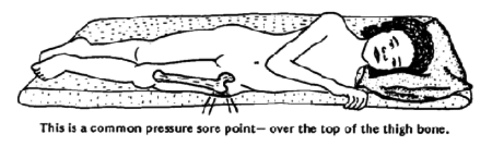 This is a common pressure sore point-over the top of the thigh bone.