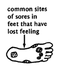 Common sites of sores in feet that have lost feeling.