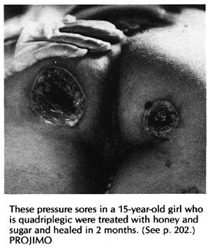 These pressire sores in a 15-year-old girl who is quadraplegic.