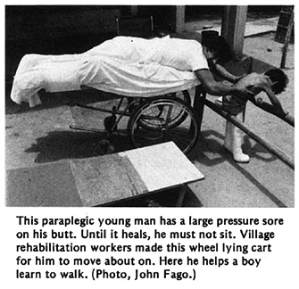 This paraplegic young man has a large pressure sore on his butt.