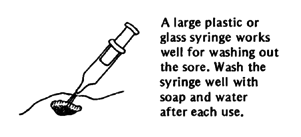 A large plastic or glass syringe works well for washing out the sore.